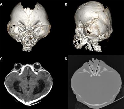 Report of a Father With Congenital Bilateral Absence of the Vas Deferens Fathering a Child With Beare–Stevenson Syndrome